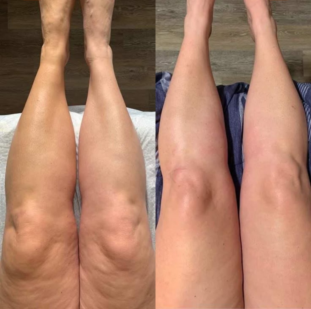 DERMAPEN REVITALIZACIJA KOŽE!